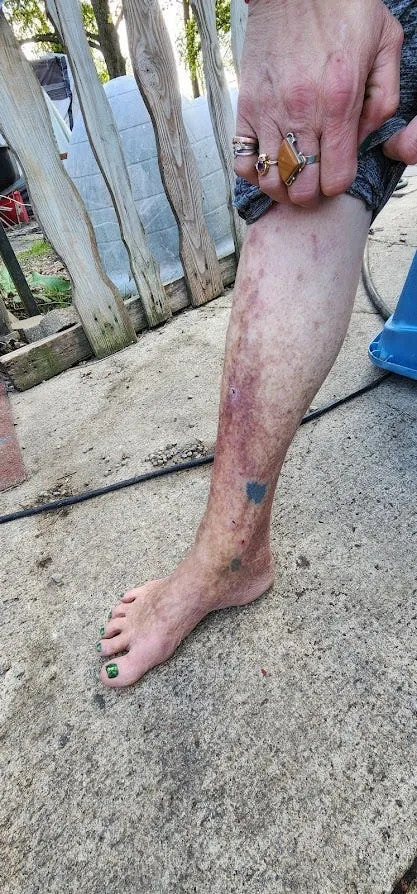 Injuries seen on Jeanna Kelley's leg, which she believes to have been from walking barefoot in her yard and coming in contact with soot in the aftermath of the My Way Trading Warehouse fire.